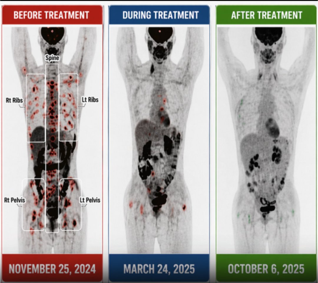 IVERMECTIN and FENBENDAZOLE Testimonial 

53-Year-Old Utah Woman with Stage 4 Breast Cancer Reaches…
